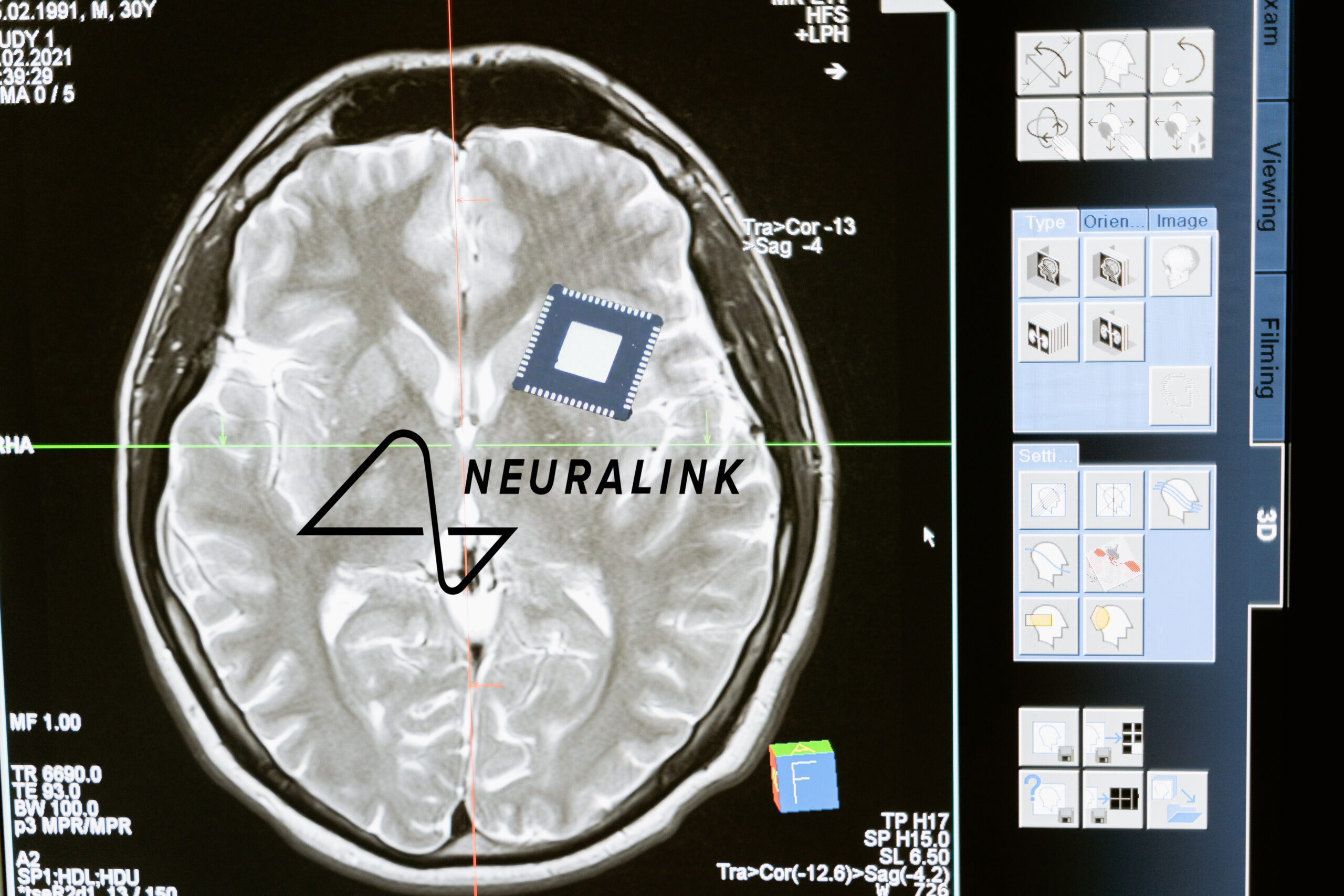 Elon Musk impianterà un chip Neuralink nel suo cervello